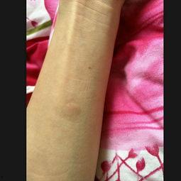 ppd皮试视频,PPD皮试操作步骤及注意事项解析