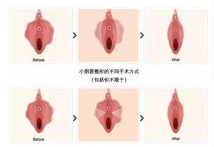 阴唇整形视频,专业视角下的美丽重塑